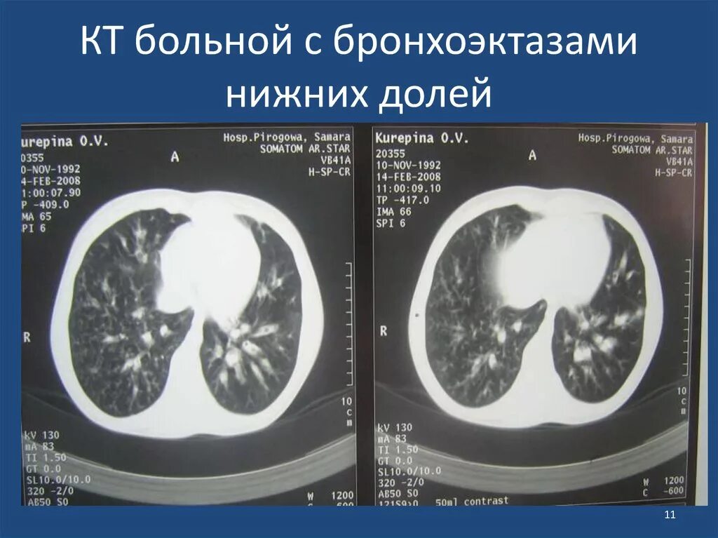 кт легких норма. крупозная пневмония кт. снимок кт легких. бронхоэктатическая болезнь компьютерная томография. метод компьютерной томографии.