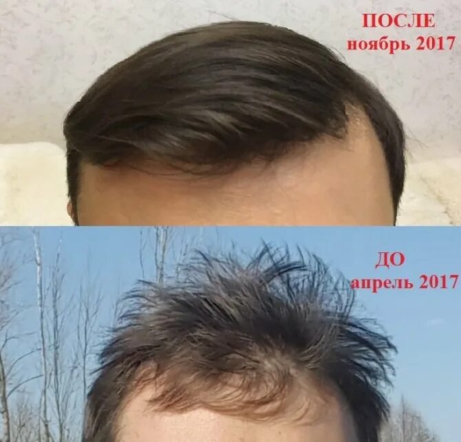 Маска от облысения для мужчин. Маска для волос от лысины. Волосы до и после рост волос. Маски для волос для мужчин от облысения.