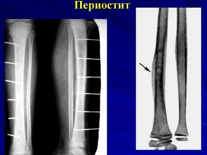 Периостит кости