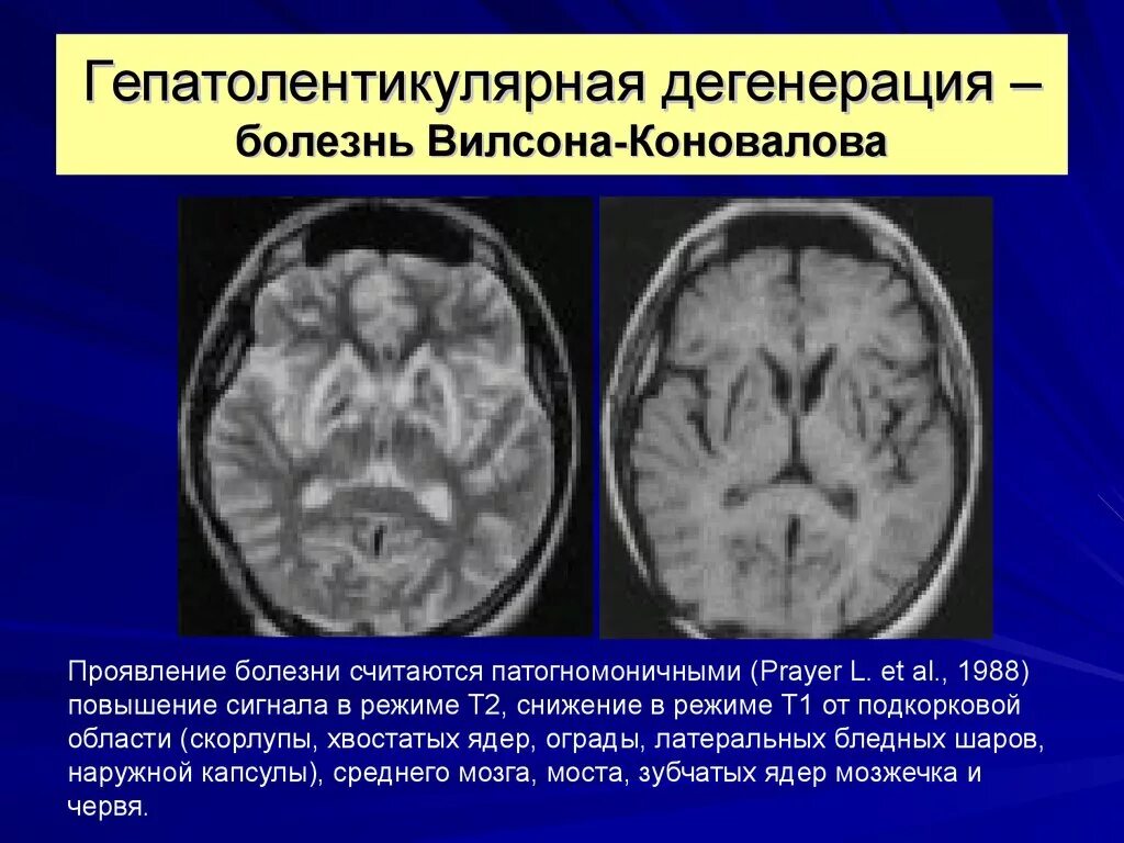 Дегенерация головного. Болезнь Вильсона Коновалова мрт головного мозга. Болезнь Вильсона Коновалов МР. Мрт головного мозга при болезни Вильсона Коновалова. Гепатолентикулярная дегенерация болезнь Вильсона Коновалова.