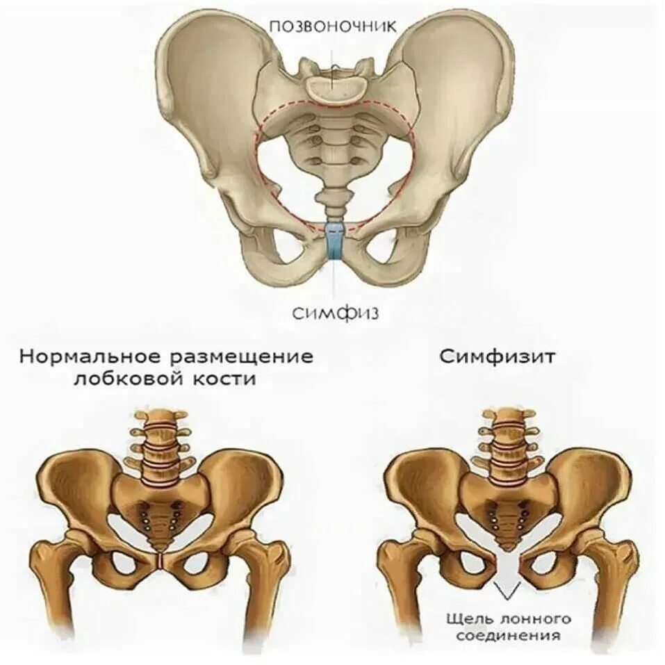 Лобковые кости соединение. Расхождение костей лобкового симфиза при беременности. Кости лонного сочленения при беременности. Симфизит тазобедренного сустава.