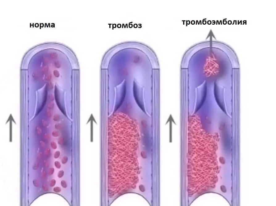 Эмболия тромбы