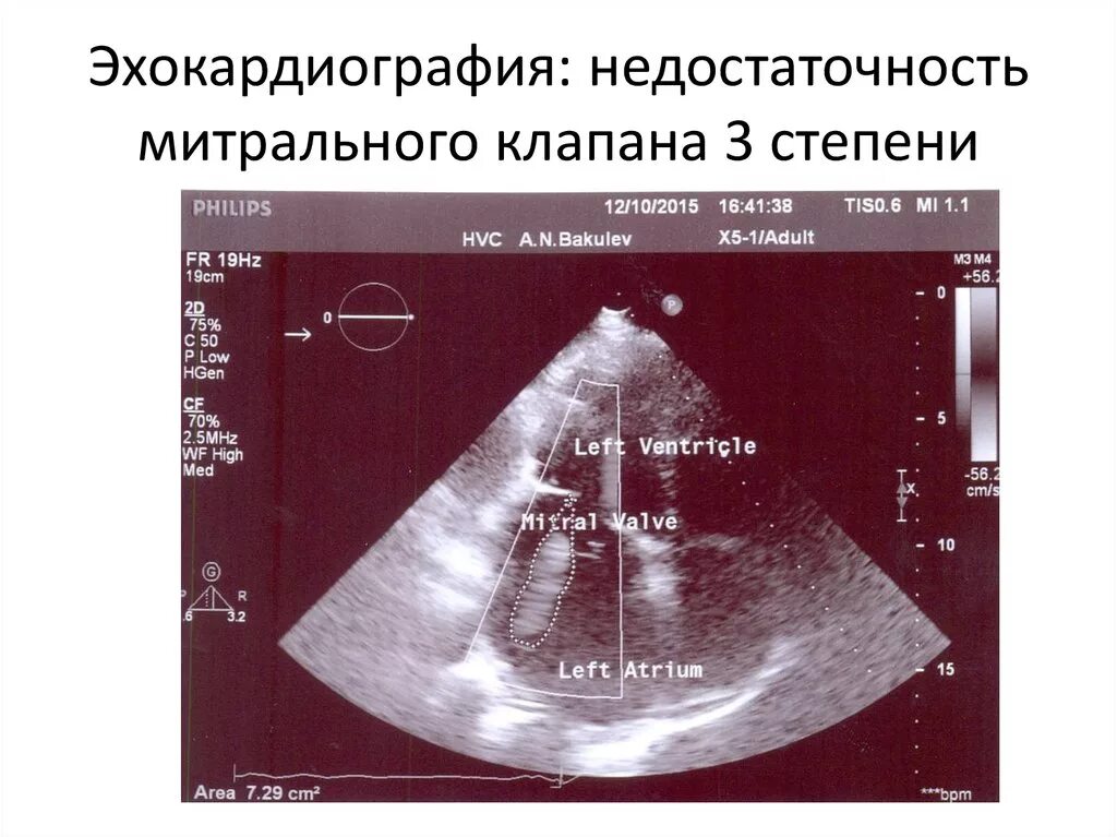 Митральная недостаточность узи. Митральный клапан на эхокг. Эхо-кг при стенозе митрального клапана. Створки митрального клапана на эхокг. Пролапс митрального клапана 1 степени на эхокг.