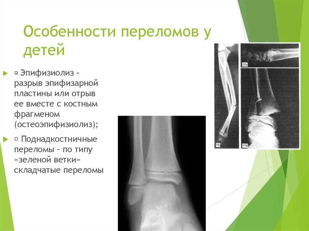 Частые переломы костей у детей