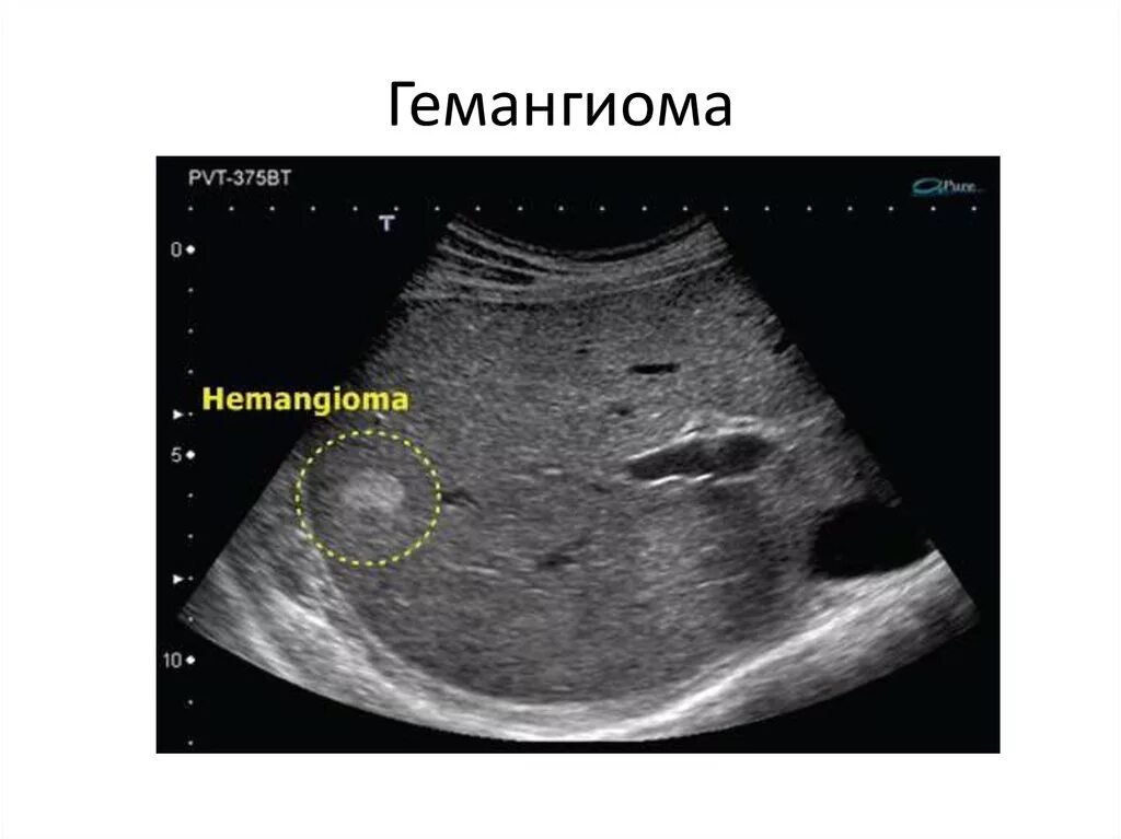 Гемангиома печени причины и лечение