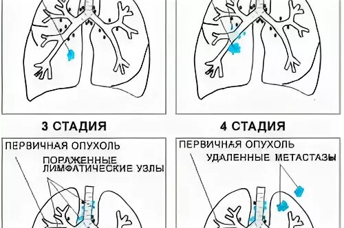 Стадии онкологии легкого. Онкология легких 4 стадия. Вылечили рак 4 стадии с метастазами