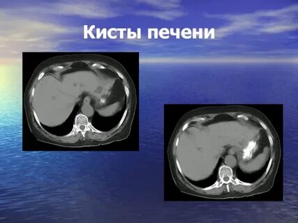 Киста печени лечение отзывы