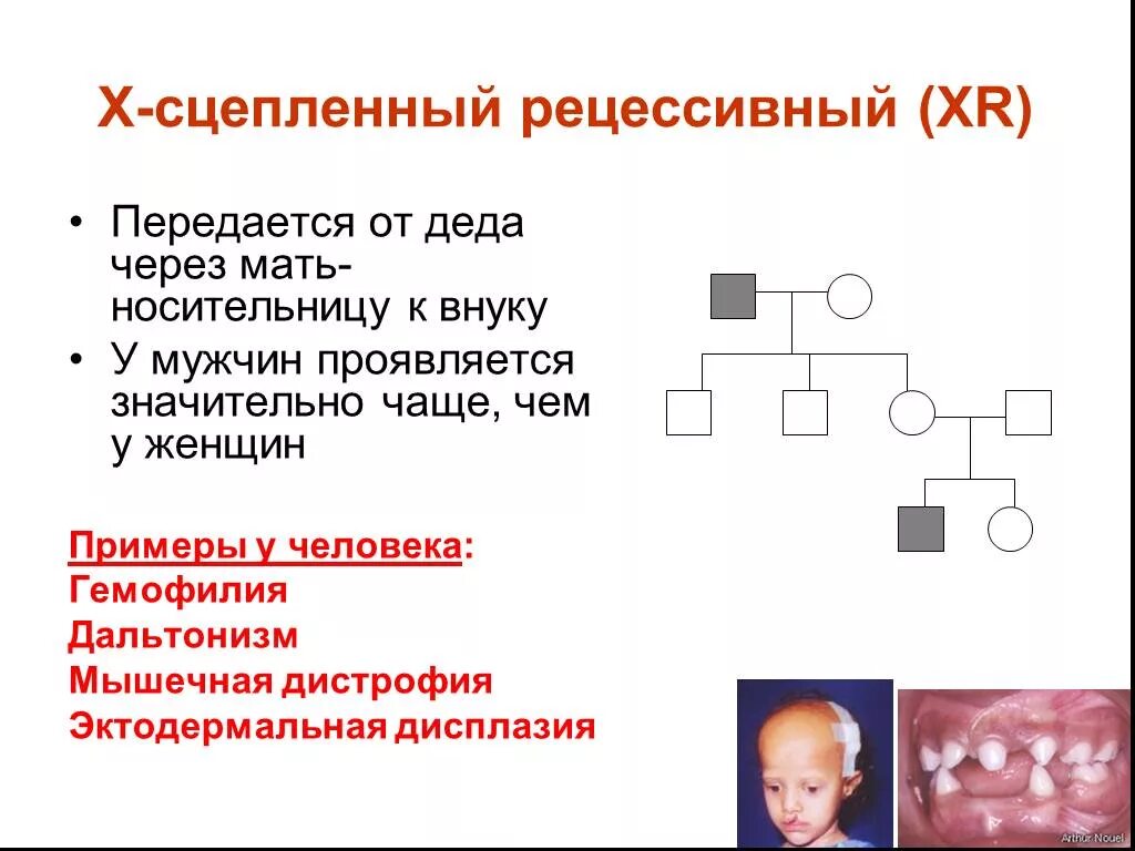 Х сцепленный рецессивный Тип наследования. Х-сцепленные рецессивные заболевания. У-сцепленный. Гемофилия рецессивный признак сцепленный.