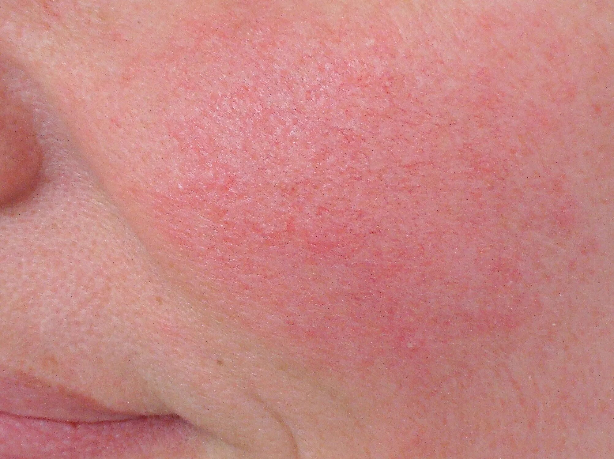 Реакция раздражение свет. Человек закрывается от яркого света. Фотодерматоз крапивница. Реакция на внешние воздействия. Холинергическая крапивница.