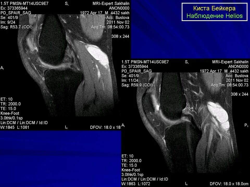 Кисты подколенной ямки киста Бейкера. Синовиальная киста коленного сустава мрт. Киста коленного сустава на кт. Киста Бейкера гонартроз.