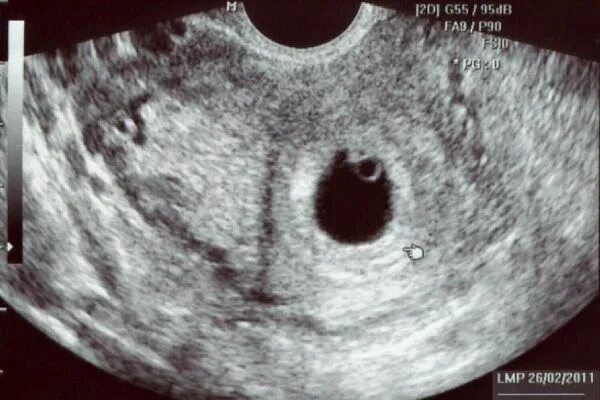 Анэмбриония на УЗИ 6 недель. Пя 9.9 мм желточный мешок 1.1 мм анэмбриония. Плод на 5 неделе беременности УЗИ. Эмбрион на 4 неделе беременности УЗИ. Почему не видно эмбрион