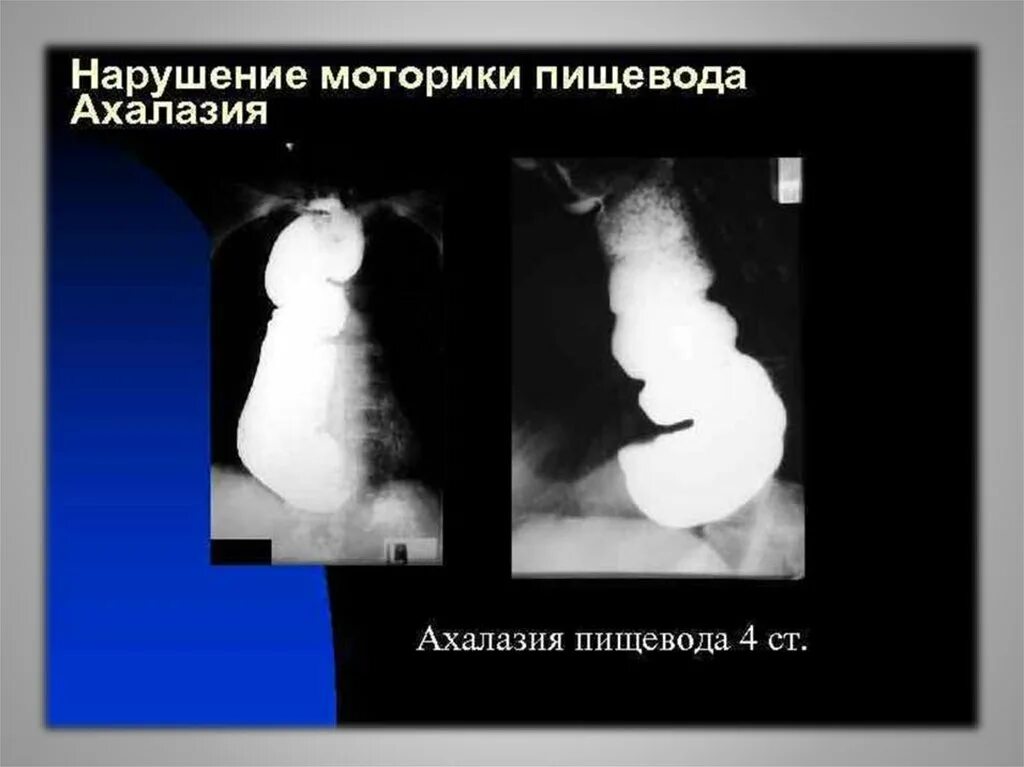 Нарушение моторики пищевода. Доброкачественные опухоли пищевода классификация. Нарушение моторики пищевода. Нарушение двигательной функции пищевода. Нарушение моторики пищевода.