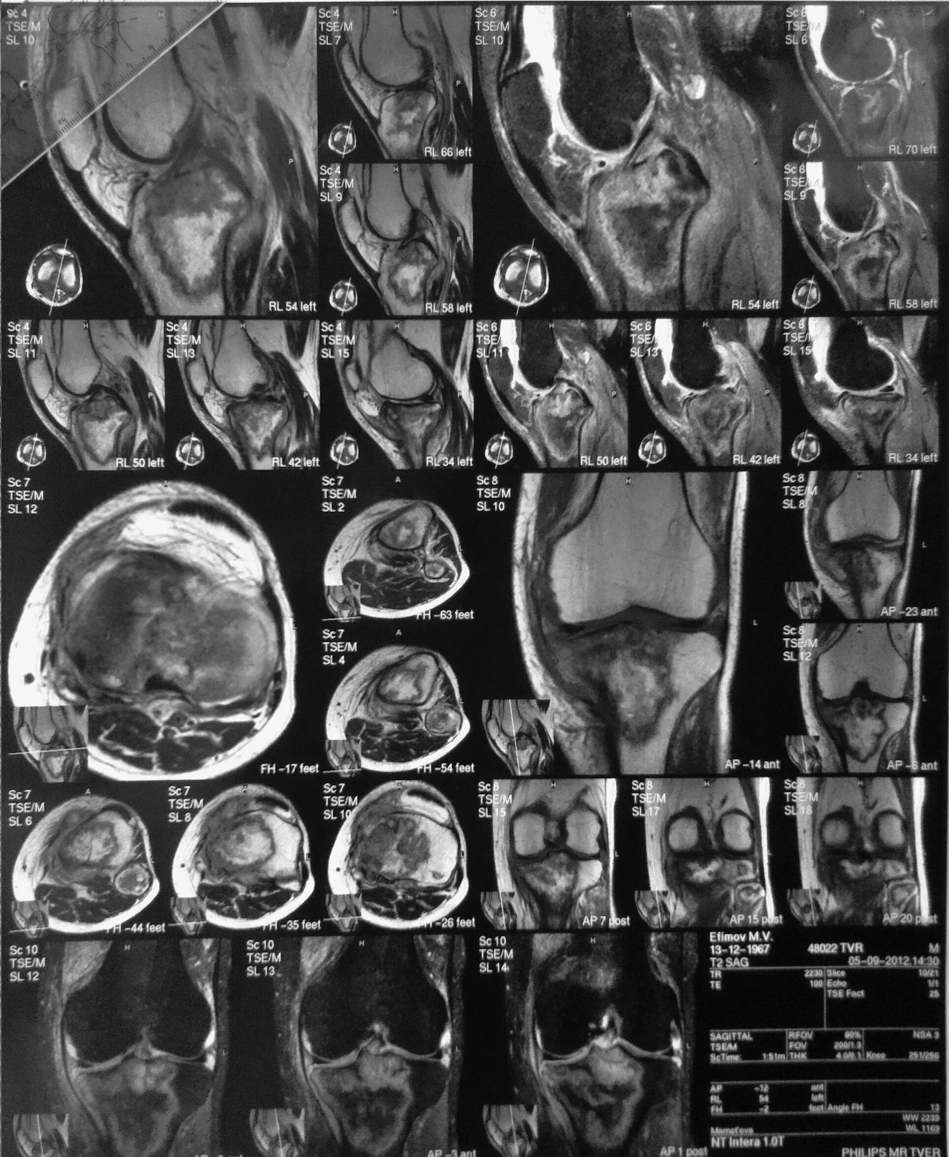 асептический некроз большеберцовой кости. асептический некроз большеберцовой кости. асептический некроз бедренной кости коленного сустава мрт. асептический некроз коленного сустава кт. асептический некроз мыщелка большеберцовой кости.