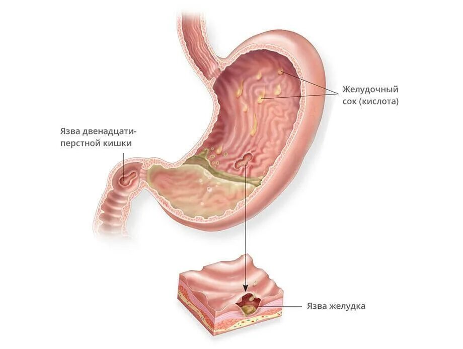 Язвенная болезнь желудка и 12 перстной кишки. Язва желудка и 12 перстной кишки. Пенетрирующая язва желудка и 12-перстной кишки. Язвенная болезнь желудка и 12-перстной кишки. Гастрит.. Простуда желудка