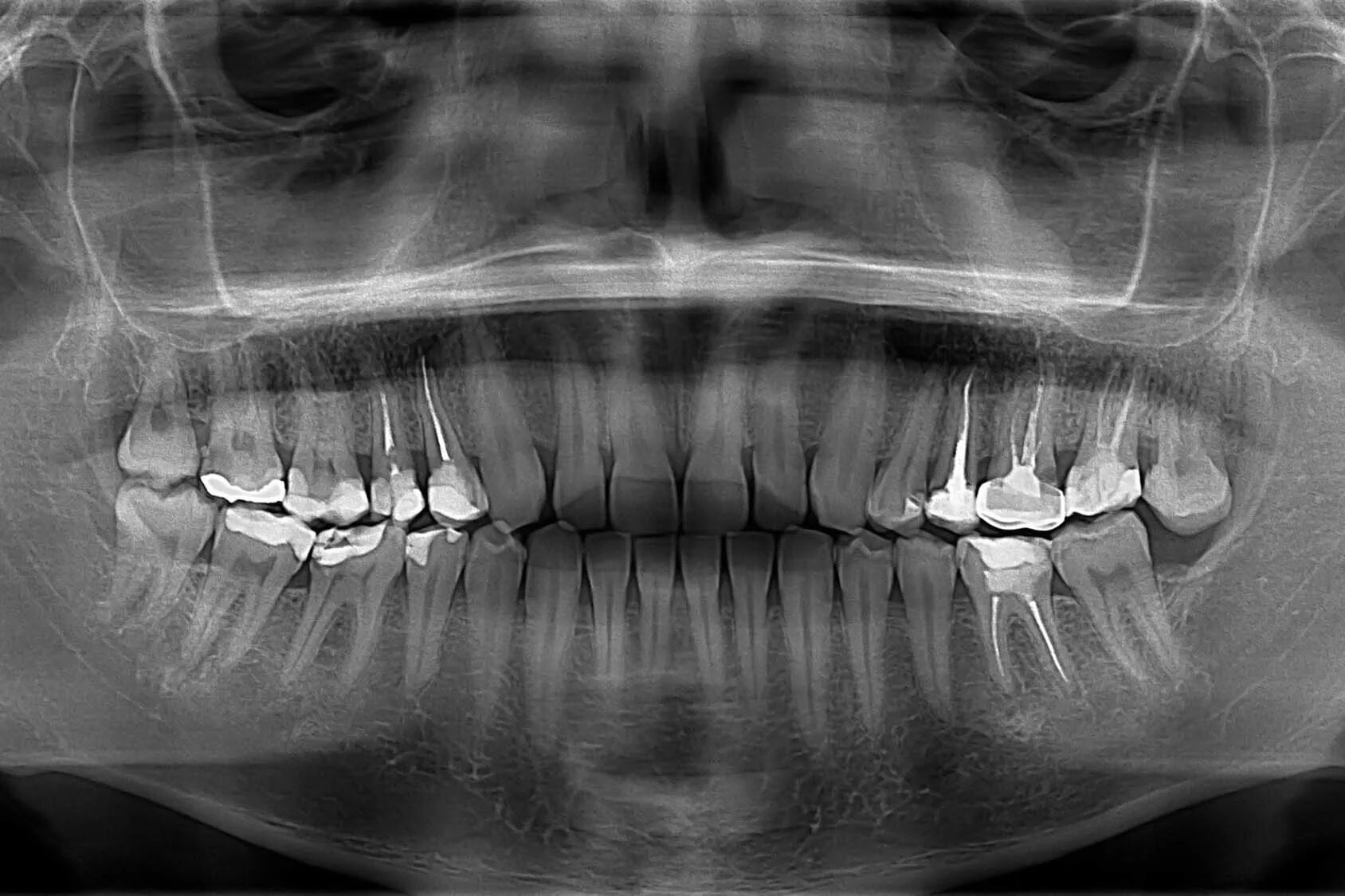 Снимок. Ортопантомограмма челюсти. Панорамный рентген зубов. Ортопантомограмма кариес. Рентген ОПТГ зубных рядов.