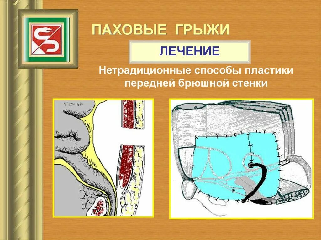 Паховая грыжа лекарства. Грыжа передней брюшной стенки. Цена лечения паховых грыж