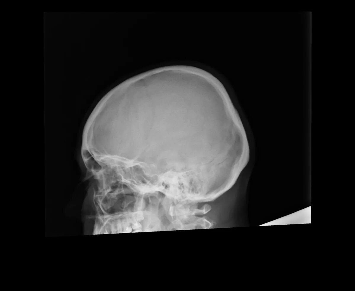 Турецкие седло кость. Кости черепа турецкое седло. Рентгенография основания черепа турецкое седло. Турецкое седло в черепе человека. RG графия черепа турецкое седло.