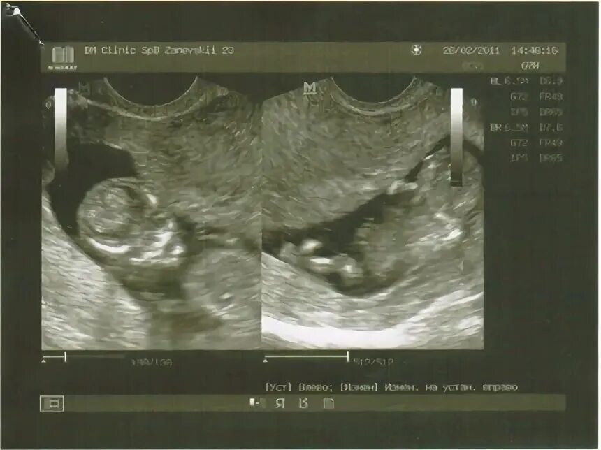 КТР эмбриона в 12 недель. КТР В 12 недель УЗИ. КТР 12.5 мм. КТР на 11-12 неделе. Ктр 11 недель