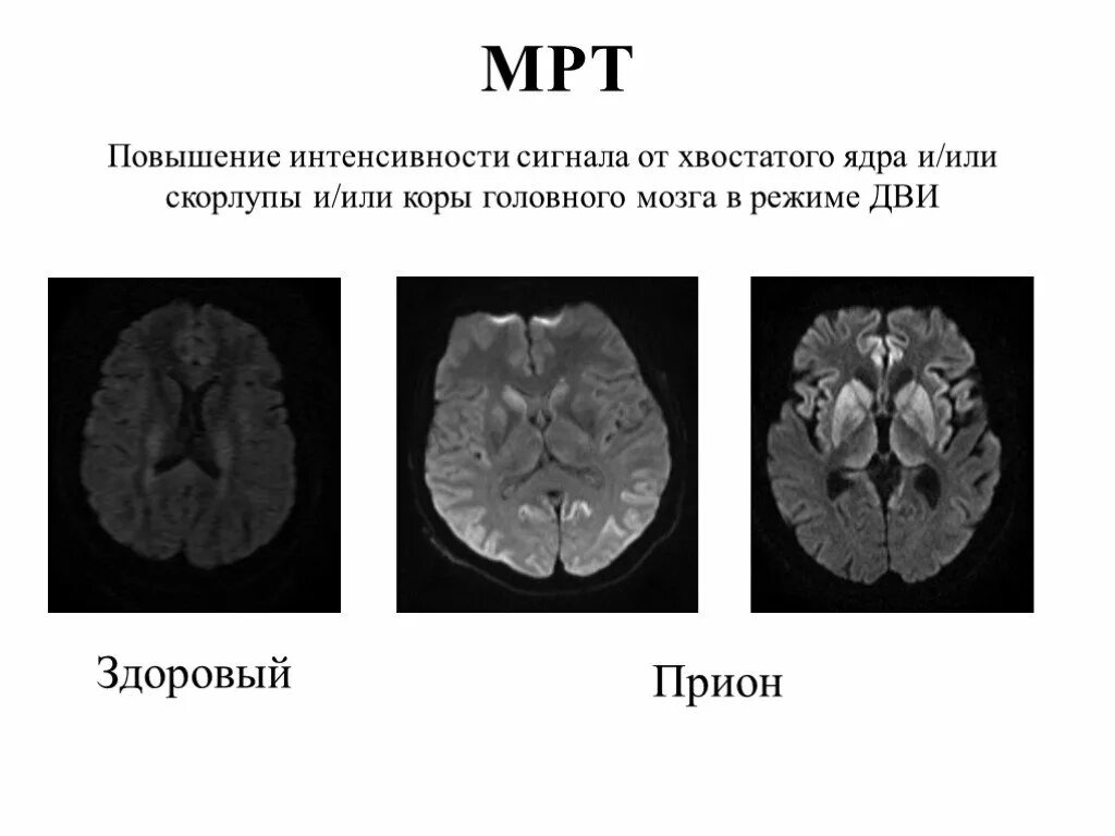 Прионы Куру Крейтцфельдта-Якоба. Прионное заболевание мозга. Прионные поражения головного мозга. Мозг при прионной болезни.