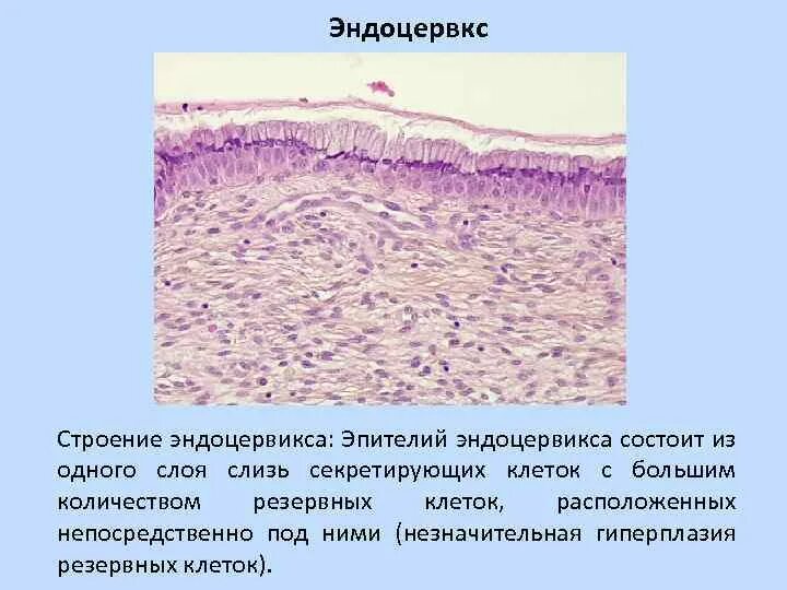 Фрагменты желез эндометрия. Железистая гиперплазия гистология. Железисто-кистозная гиперплазия гистология. Атипичная гиперплазия эндометрия гистология. Эндометриальный полип матки гистология.