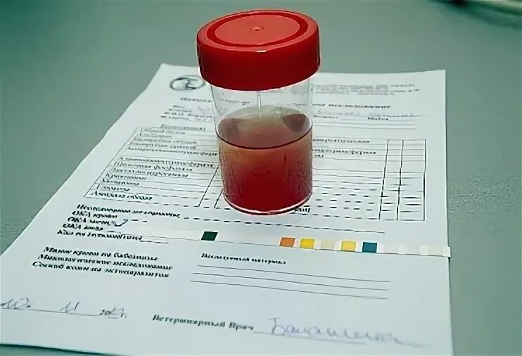 Моча розового цвета у ребенка. Красноватый оттенок мочи у женщин. розовая моча у женщин. красный цвет мочи у женщин причины.