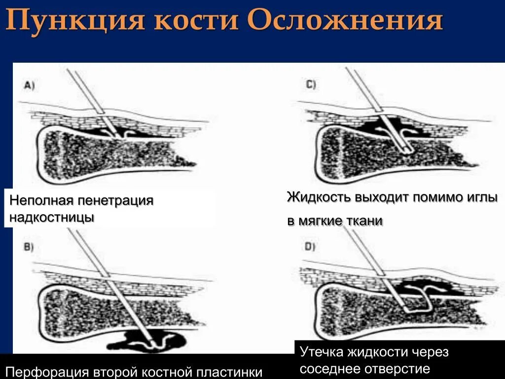 Стернальная пункция спинного мозга. Костно мозговая пункция. Осложнение пункции спинного мозга.