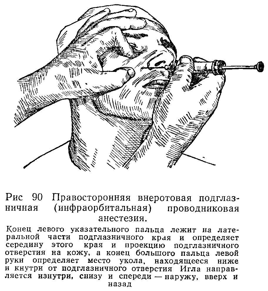 Внеротовая инфраорбитальная анестезия. Проводниковая анестезия нижнечелюстного нерва. Инфраорбитальная анестезия зона обезболивания. Подглазничная анестезия внутриротовая. Проведение проводниковой анестезии