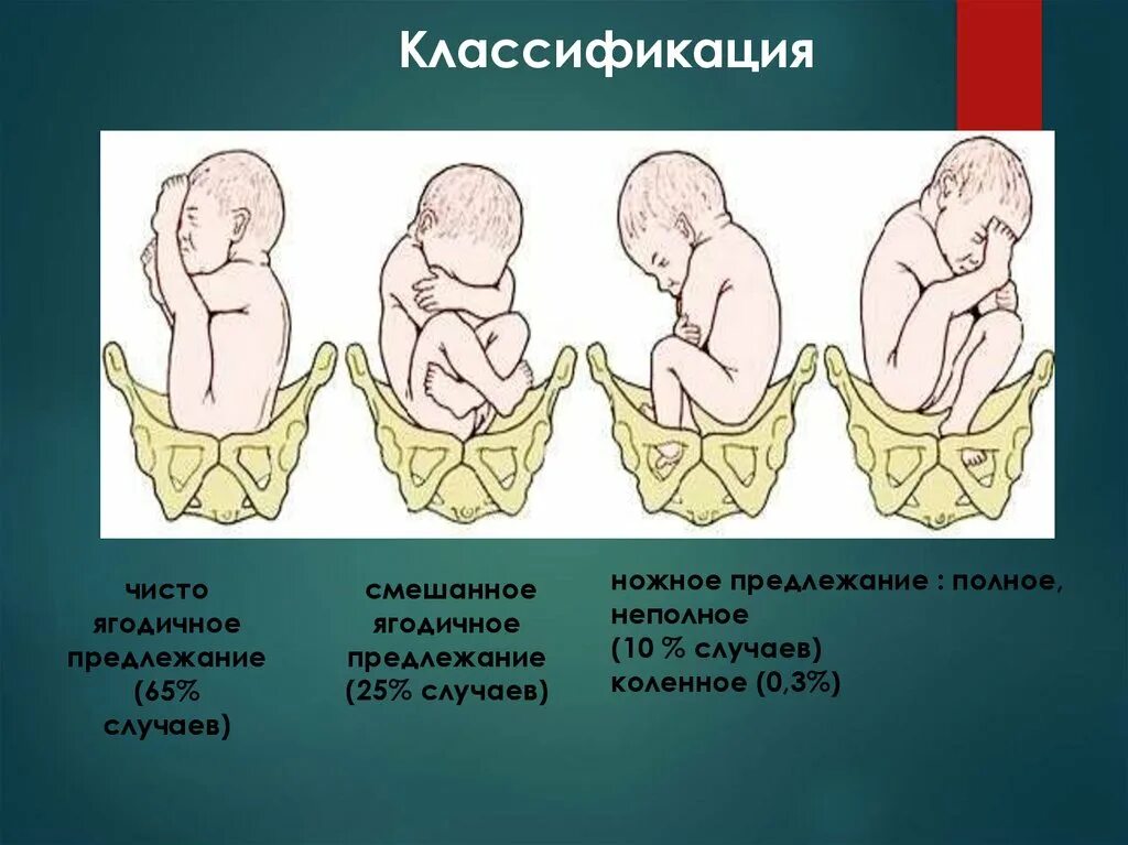 Полное предлежание форум. Смешанное ягодичное предлежание. Тазовое ножное предлежание. Смешанное ягодичное предлежание плода. Тазовое ножное предлежание плода.