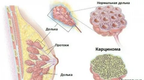 Инвазивные железы