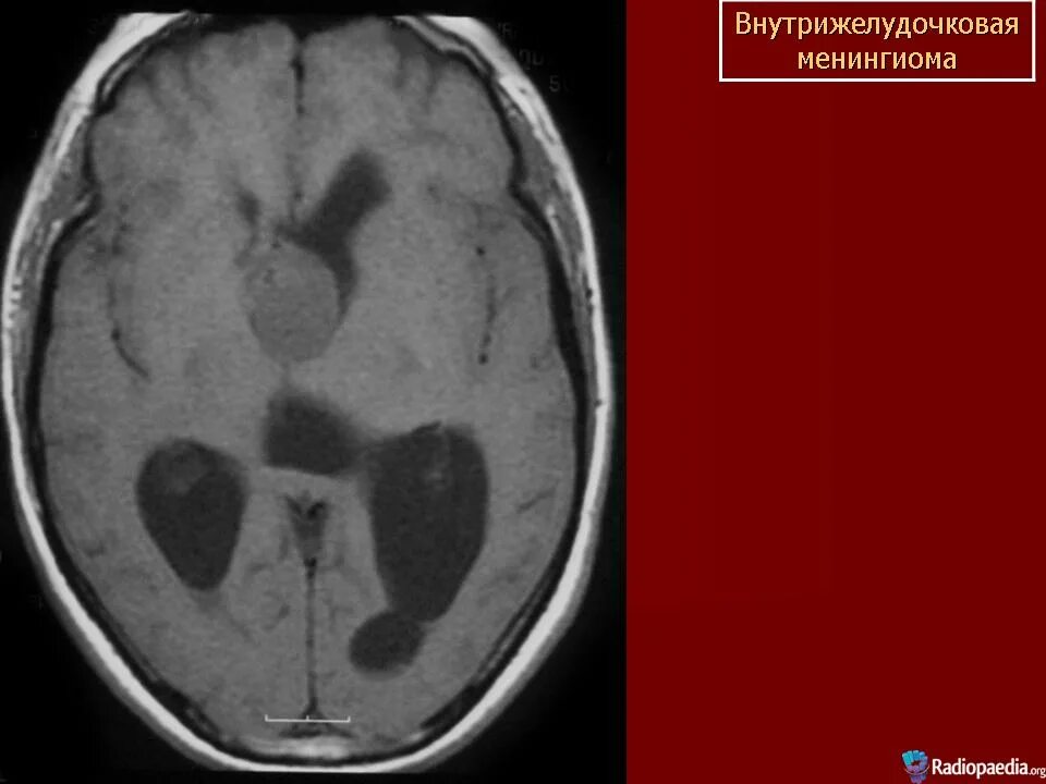 Субтенториальная менингиома. Внутрижелудочковая менингиома мрт. Менингиома 3 желудочка. После операции менингиомы головного мозга