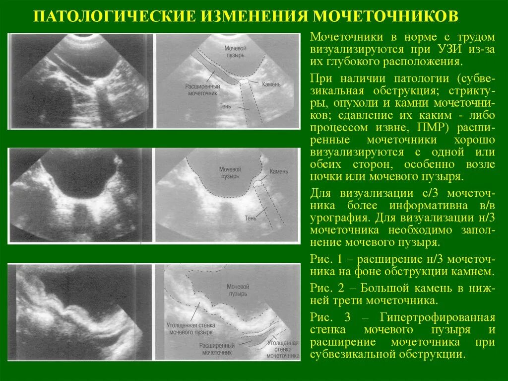 Анализ мочеточника. УЗИ почек, мочеточников и мочевого пузыря.. УЗИ мочеточников норма. Расширение нижней трети мочеточника УЗИ. Расширение верхней трети мочеточника УЗИ.