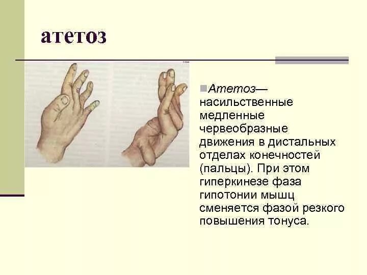Почему двигается палец. Атетоидный гиперкинез признаки. Атетозоподобные движения пальцев рук это. Атетоидные движения в кистях.