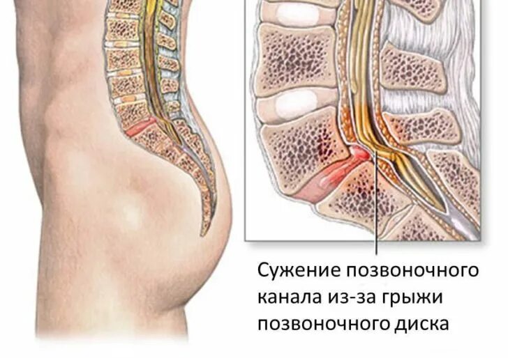 Спинальный стеноз операция. Стеноз позвоночного канала l4-l5. Дегенеративный спинальный стеноз l3-l4. Абсолютный стеноз позвоночного канала l3-l4. Стеноз позвоночного канала с4 с5.