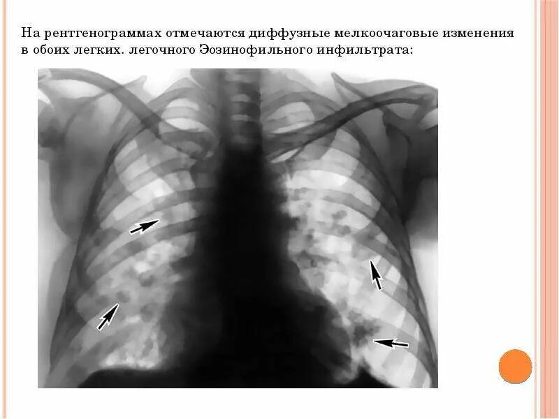 Очаговое поражение легких. Эозинофильный инфильтрат легкого рентген. Эозинофильный инфильтрат рентген. Эозинофильный инфильтрат в легких. Мелкоочаговая инфильтрация.