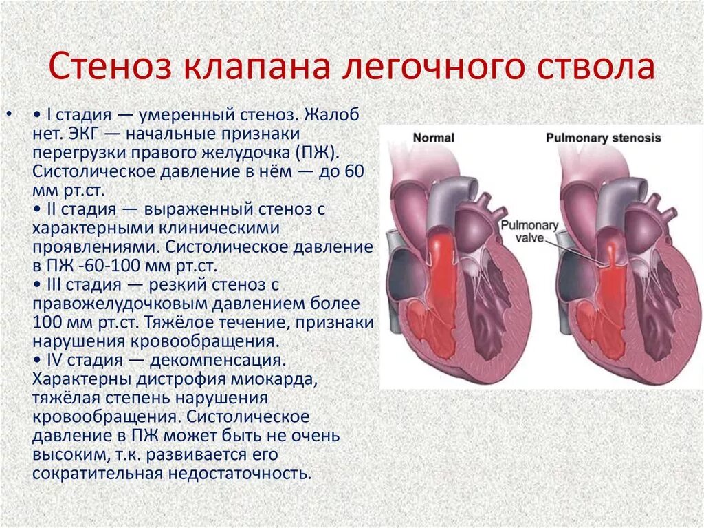 Стеноз артериального клапана