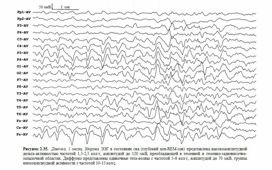 Вертексные потенциалы на ЭЭГ. ЭЭГ сна норма. Возрастные изменения на ЭЭГ У детей. ЭЭГ здорового ребенка. Ээг дневное ребенку