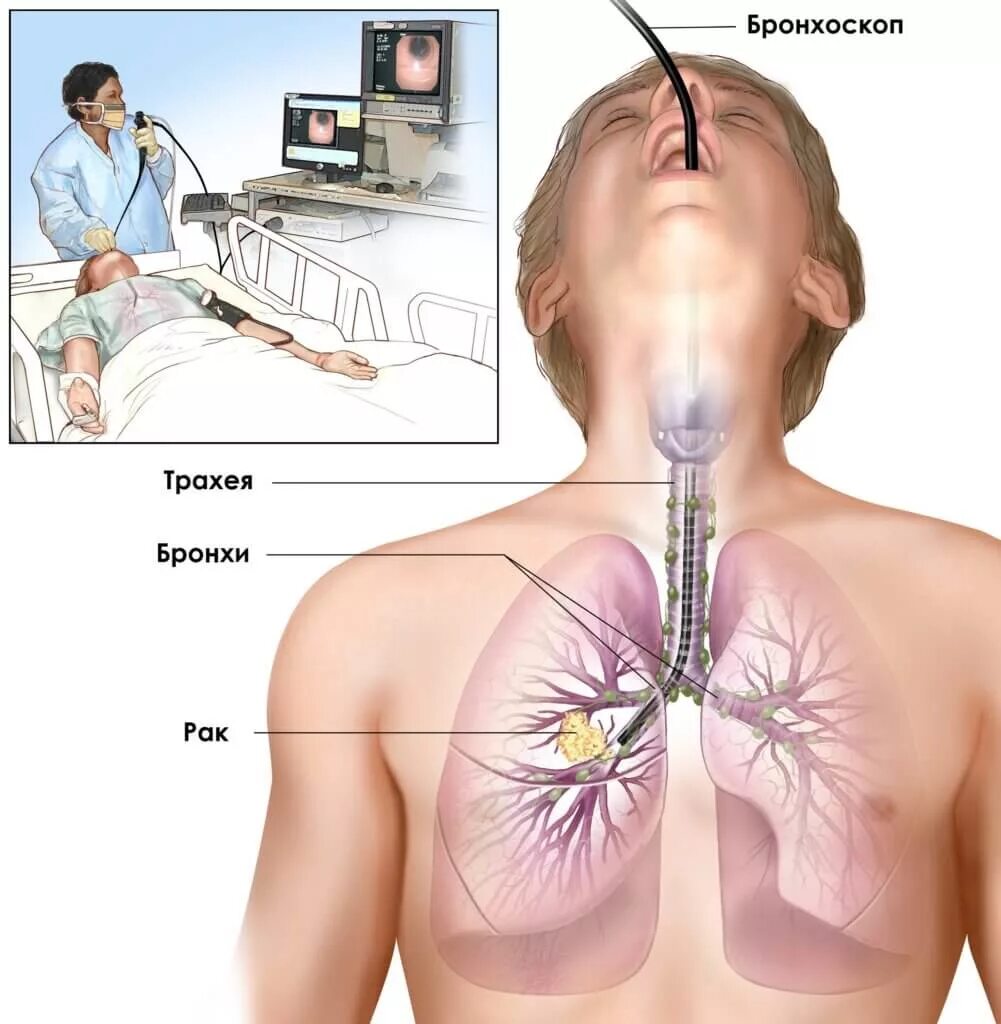 Врач по бронхиту. Бронхоскопия и бронхография. Эндоскопическое исследование бронхов. Бронхоскопия метод исследования.