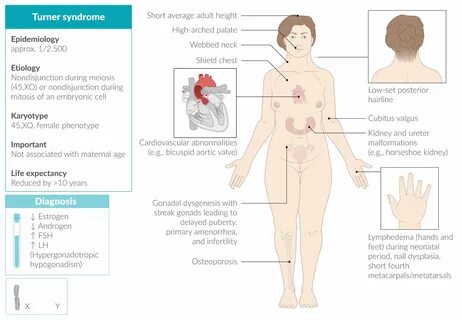 Actors with turner syndrome