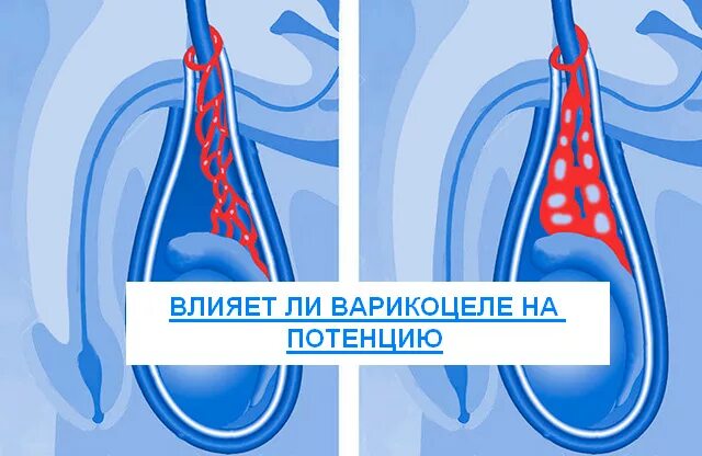 Расширение вен канатика. Варикоз вен семенного канатика. Варикозное расширение вен семенного канатика III степени.