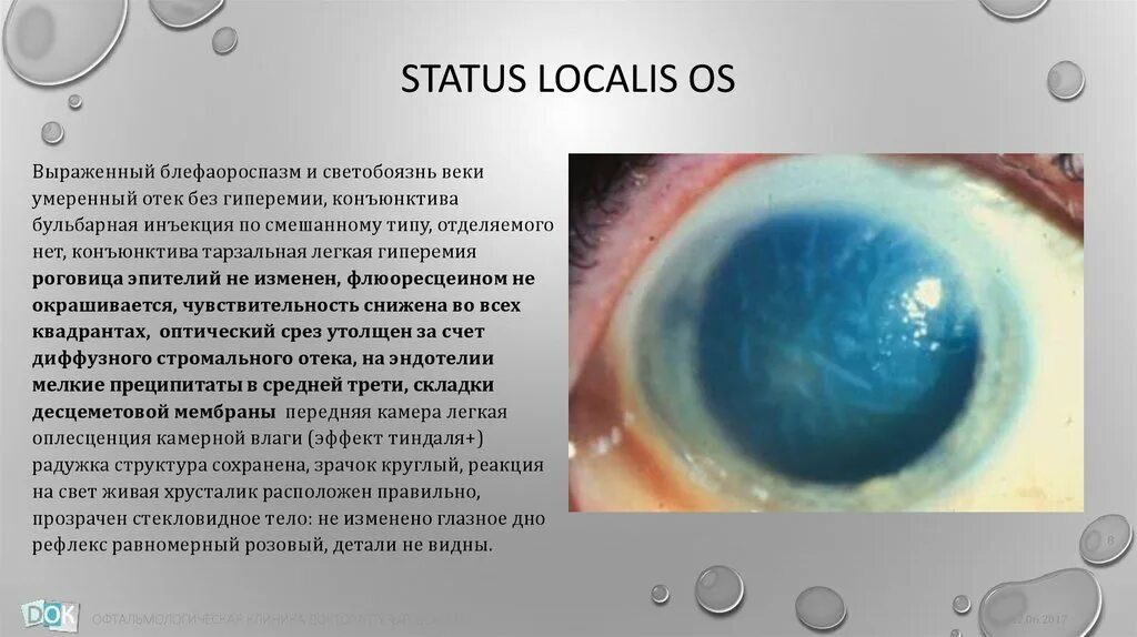 Статус локалис раны. Кератит статус локалис. Химический ожог роговицы. Конъюнктивит статус локалис. Тиндаля в офтальмологии.