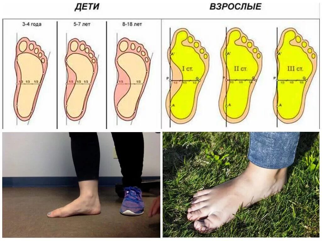 Какого цвета стоп. Продольно-поперечное плоскостопие 3 степени. Плоскостопие 1, 2, 3 степени. Продольно-поперечное плоскостопие и вальгус 3 степени. Степени плоскостопия 3 степени.