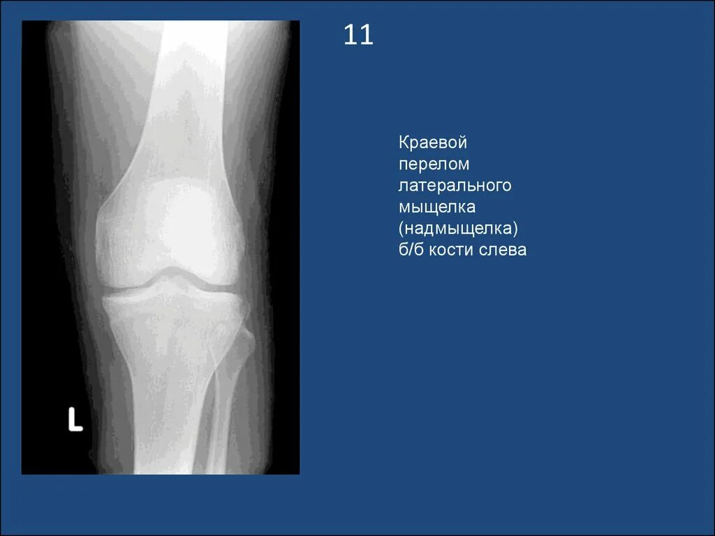 Краевой перелом большеберцовой кости рентген. Продольный перелом мыщелка бедренной кости. Перелом мыщелков большеберцовой кости. Перелом мыщелков большеберцовой кости рентген. Латерального мыщелка