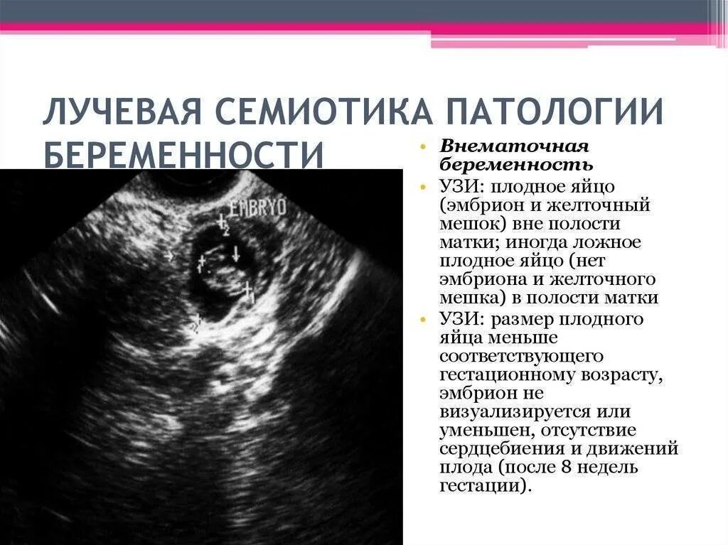Срок видят эмбрион. Что такое не визуализируется на узи эмбрион. плодное яйцо не визуализируется. патологии беременности на узи.