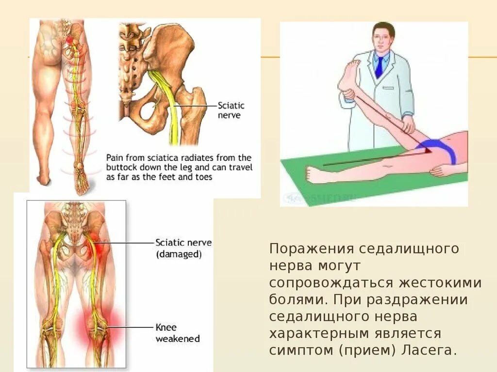 Сильно болит седалищный нерв. Поражение седалищного нерва симптомы. Седалищный нерв симптомы у женщин. Воспаление сидальческого нерва.