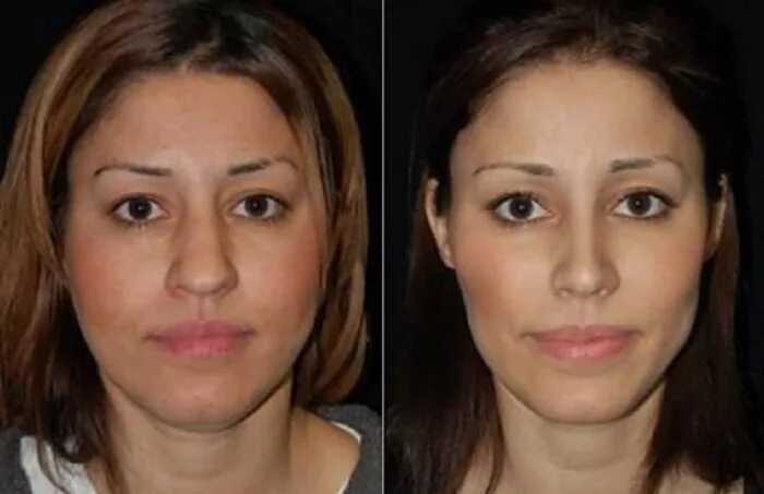 Мелоян мхитар мисакович ринопластика. Удалить скулы. Операция на скулы. Натали портман скулы. Удалить скулы.