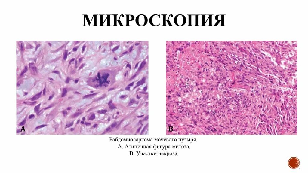 Мезенхимальная опухоль гистология. Саркома мезенхимальная опухоль. Мезенхимальные злокачественные опухоли патанатомия. Доброкачественные опухоли мезенхимального происхождения. Опухоли мезенхимального происхождения