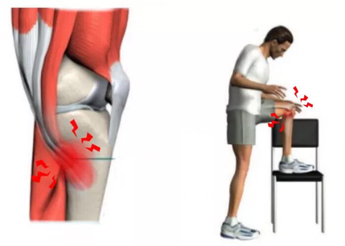 Бурсит гусиной лапки анатомия. Бурсит гусиной лапки анатомия. Поверхностная гусиная лапка коленного сустава анатомия. Тендинопатия сухожилия гусиной лапки. Анзериновая сумка коленного сустава.