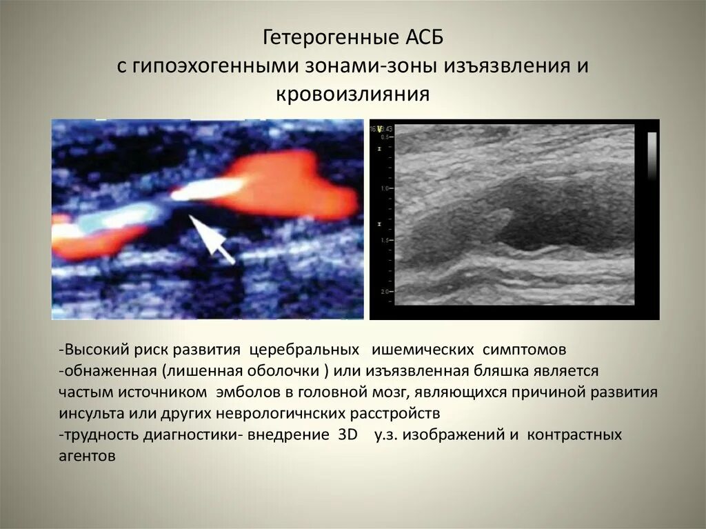Атеросклеротическая бляшка узи. Гетерогенная атеросклеротическая бляшка. гипоэхогенная бляшка. гетерогенная асб что это. гетерогенная бляшка на узи.