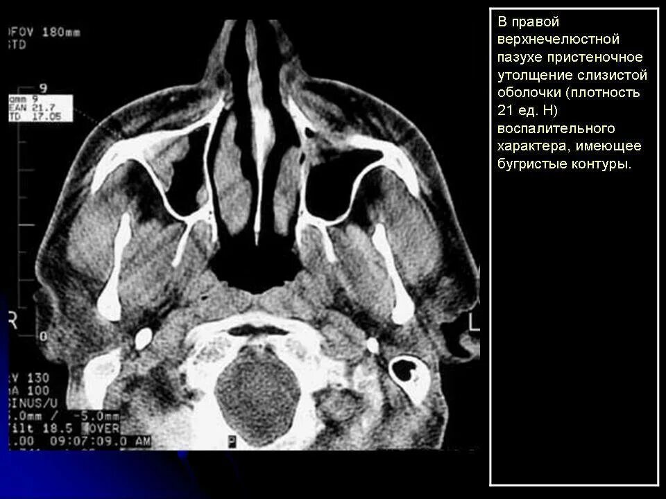 Опухоль верхнечелюстной пазухи на мрт. Опухоль гайморовой пазухи на мрт. Опухоль решетчатого Лабиринта кт. Опухоль в гайморовой пазухе на кт. Пристеночный отек слизистой