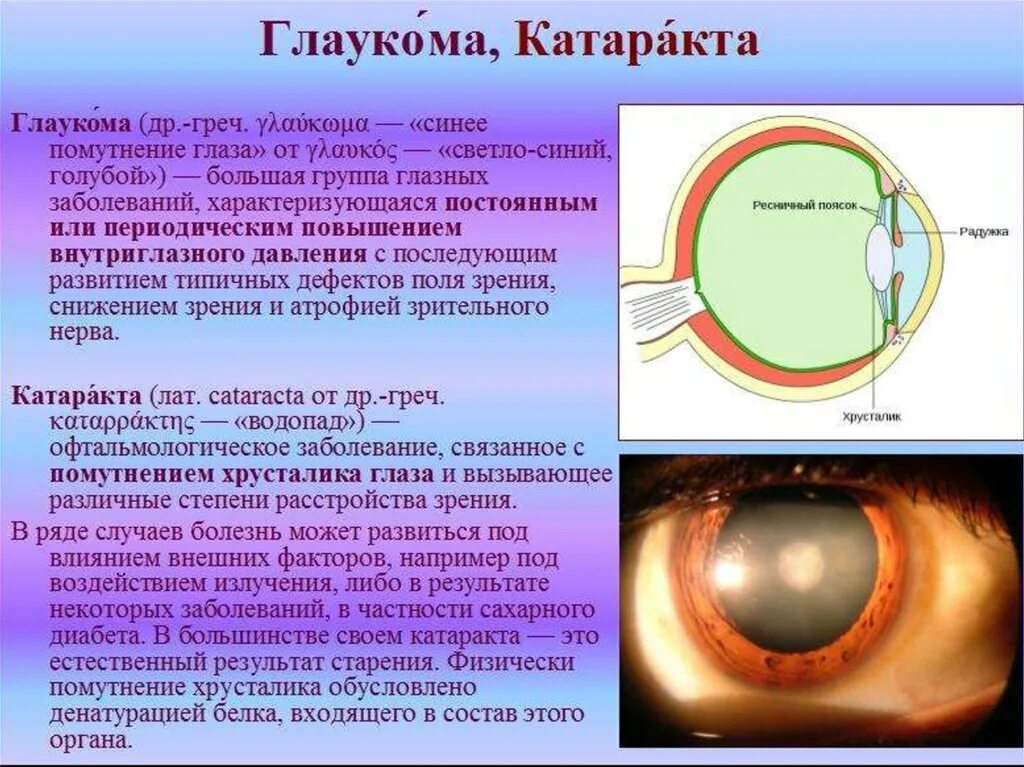 Что делать при глаукоме глаза. Глаукома и катаракта отличия. Глаукома и катаракта глаза симптомы. Глаза катаракта глаукома.